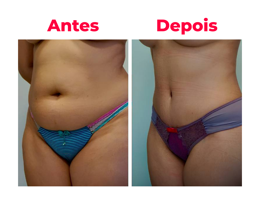 Antes e depois 1 - resultado da técnica