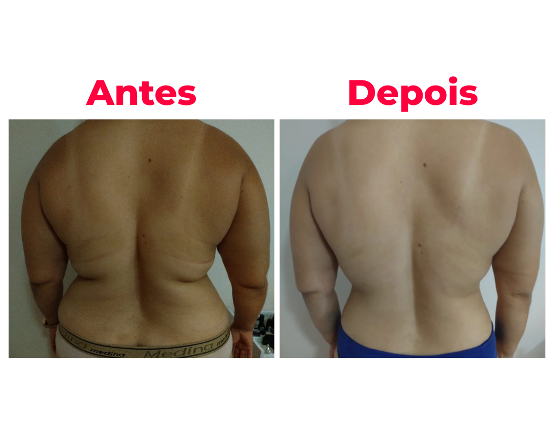 Antes e depois 2 - resultado da técnica