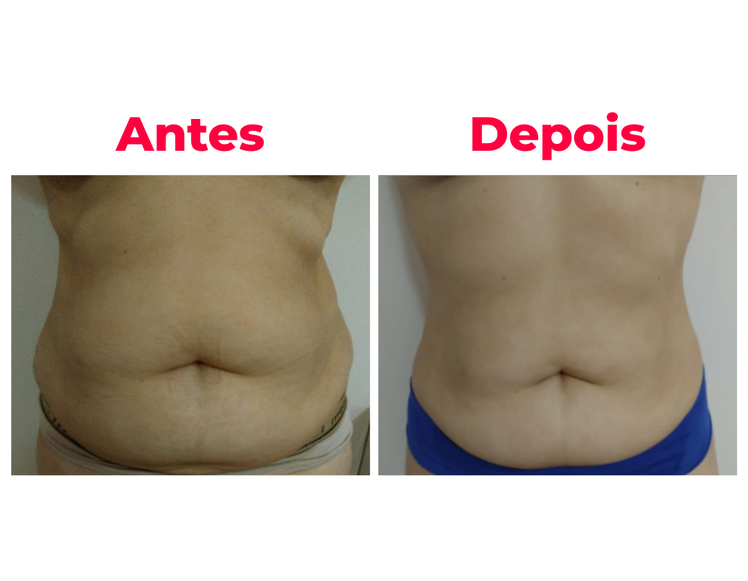 Antes e depois 3 - resultado da técnica