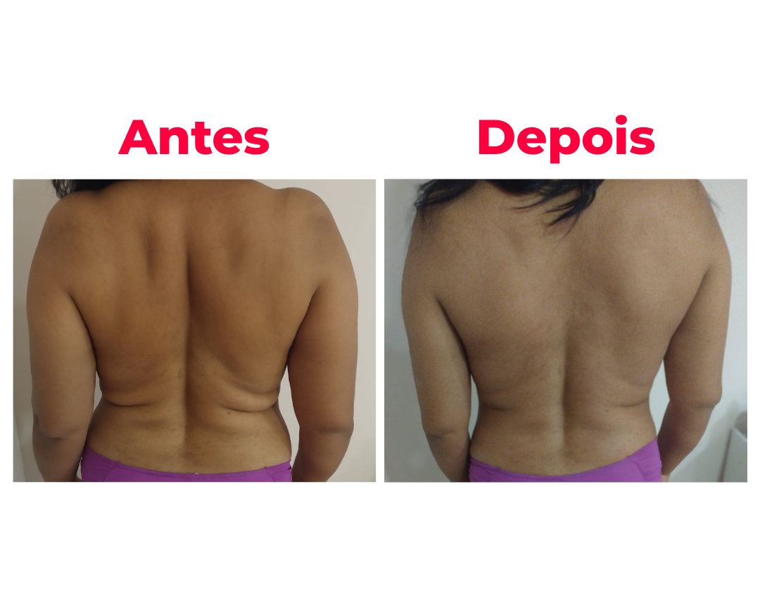 Antes e depois 4 - resultado da técnica